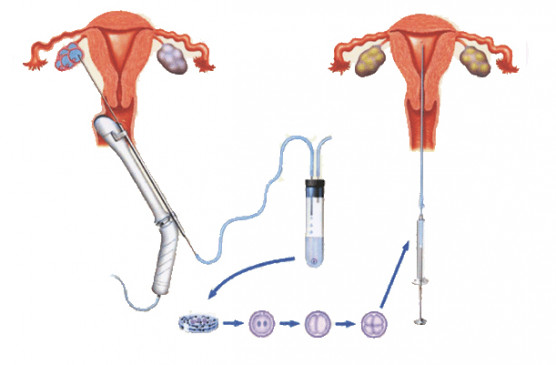  IVF ศิริราช ราคา 2565